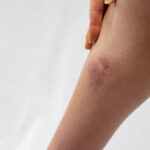 【論文/感染症】小児におけるRoseomonas mucosaによる蜂窩織炎の症例報告