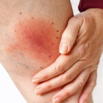 【論文/感染症】Mycobacterium haemophiliumによる皮膚感染症の新たな症例：診断上の課題